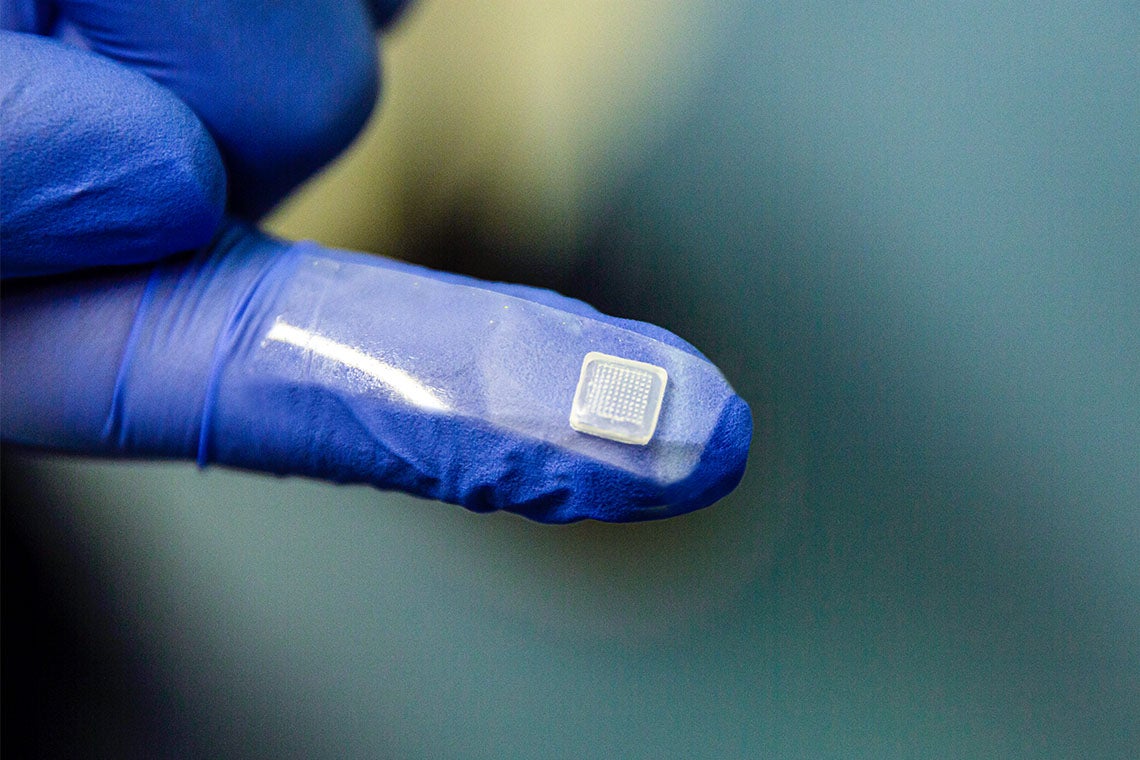 Photo of the skin patch on the finger of a purple rubber glove