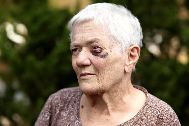 Photo of older person with black eye