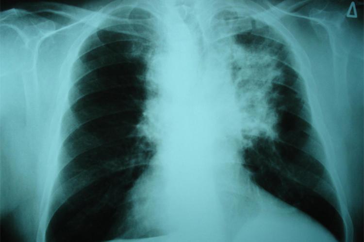 photo of a chest x-ray