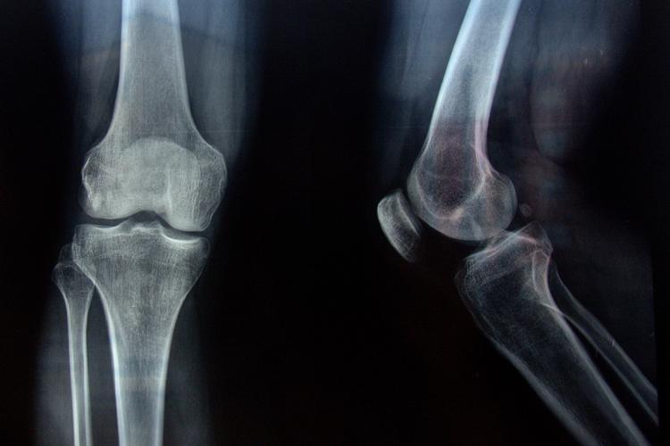 x-ray of knees