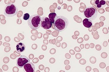Image of leukemia cells