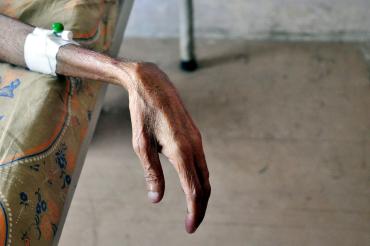 photo of TB patient's hand