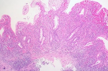 Colon biopsy showing ulcerative colitis