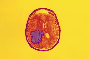 A scan depicting brain cancer.