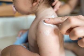 infant with chickenpox receives some ointment from their mother